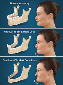 Full Arch Dental Implants Kirkwood