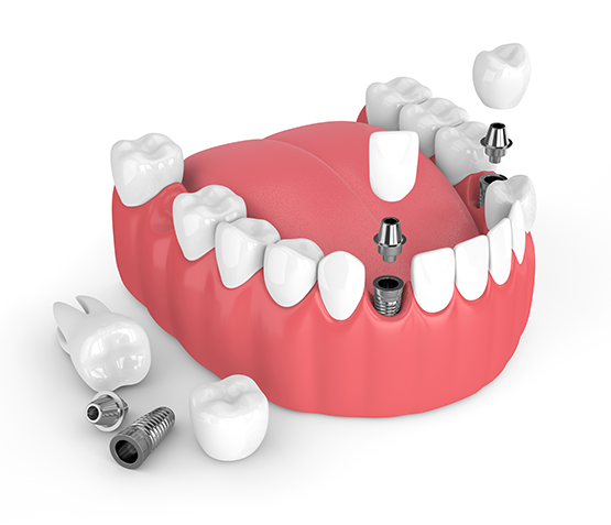Dental Implants Kirkwood MO